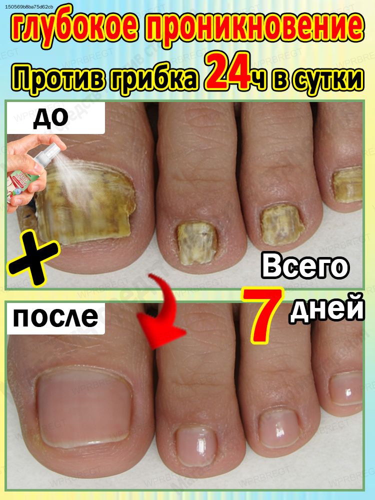 Спрейдляудаленияонихомикоза,уничтожаетгрибкиза24часа,эффективнолечитгрибковыеинфекцииногтейнаногахиногтяхнаруках,укрепляетивосстанавливаетногти,30мл.